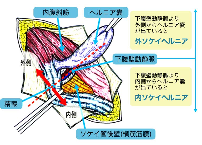 嵌頓(かんとん)状態